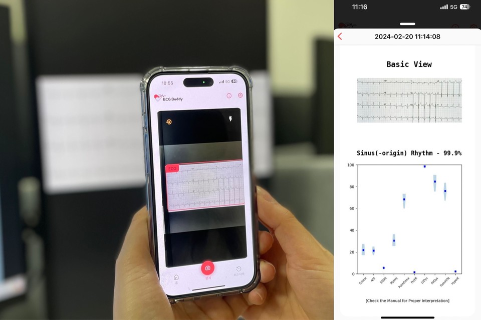 ECG Buddy 구동 예시 모습으로 스마트폰으로 심전도 이미지를 촬영(좌측)하면 분석 결과를 출력(우측)한다./사진=분당서울대병원