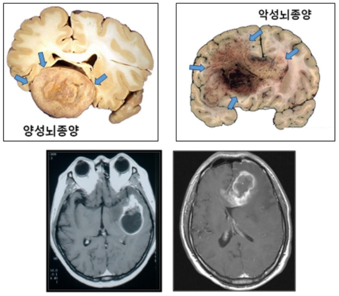 ‘뇌종양’ 적절한 치료와 관리로 극복 가능한 질환