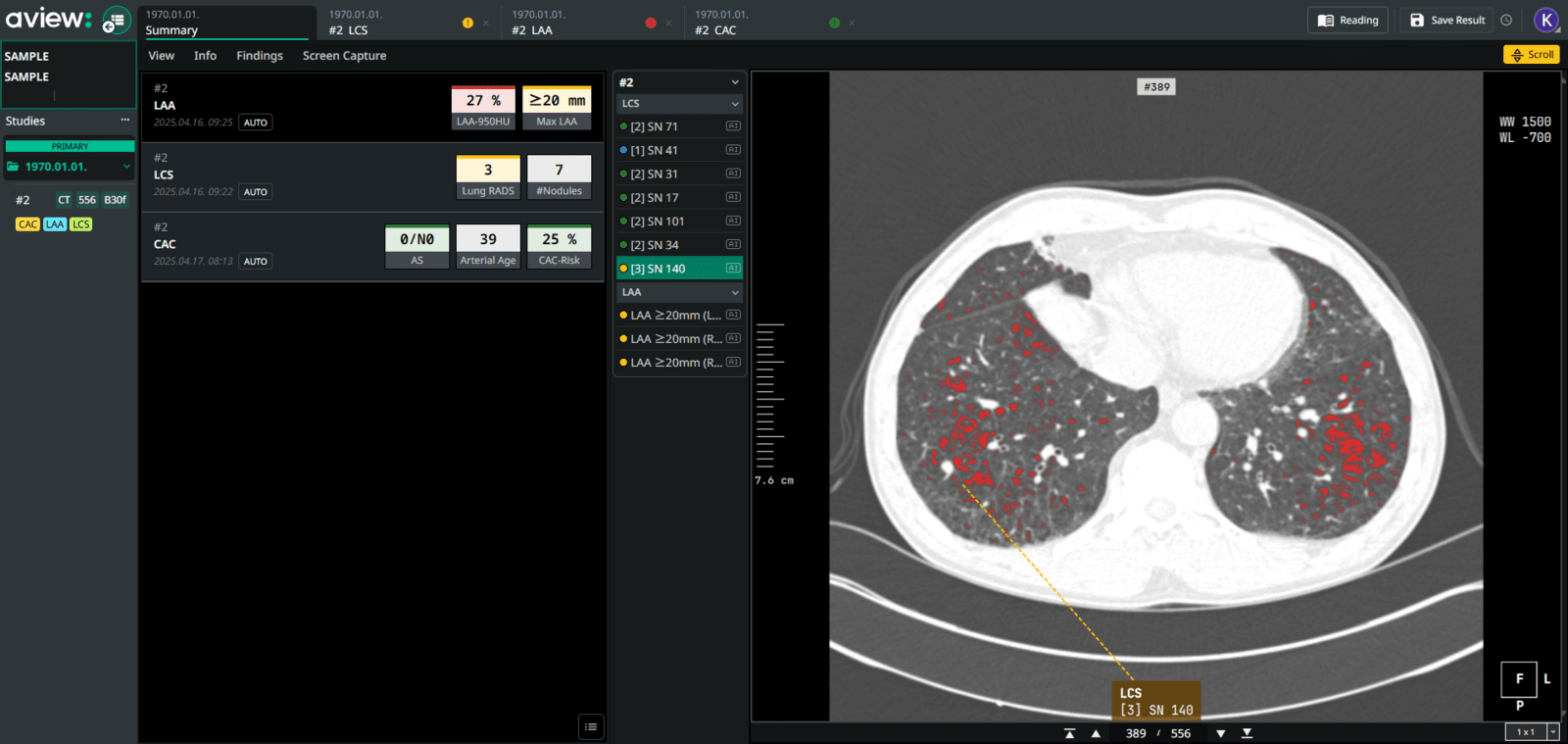 코어라인소프트, 미국 ImageCare Radiology와 AVIEW 공급 계약